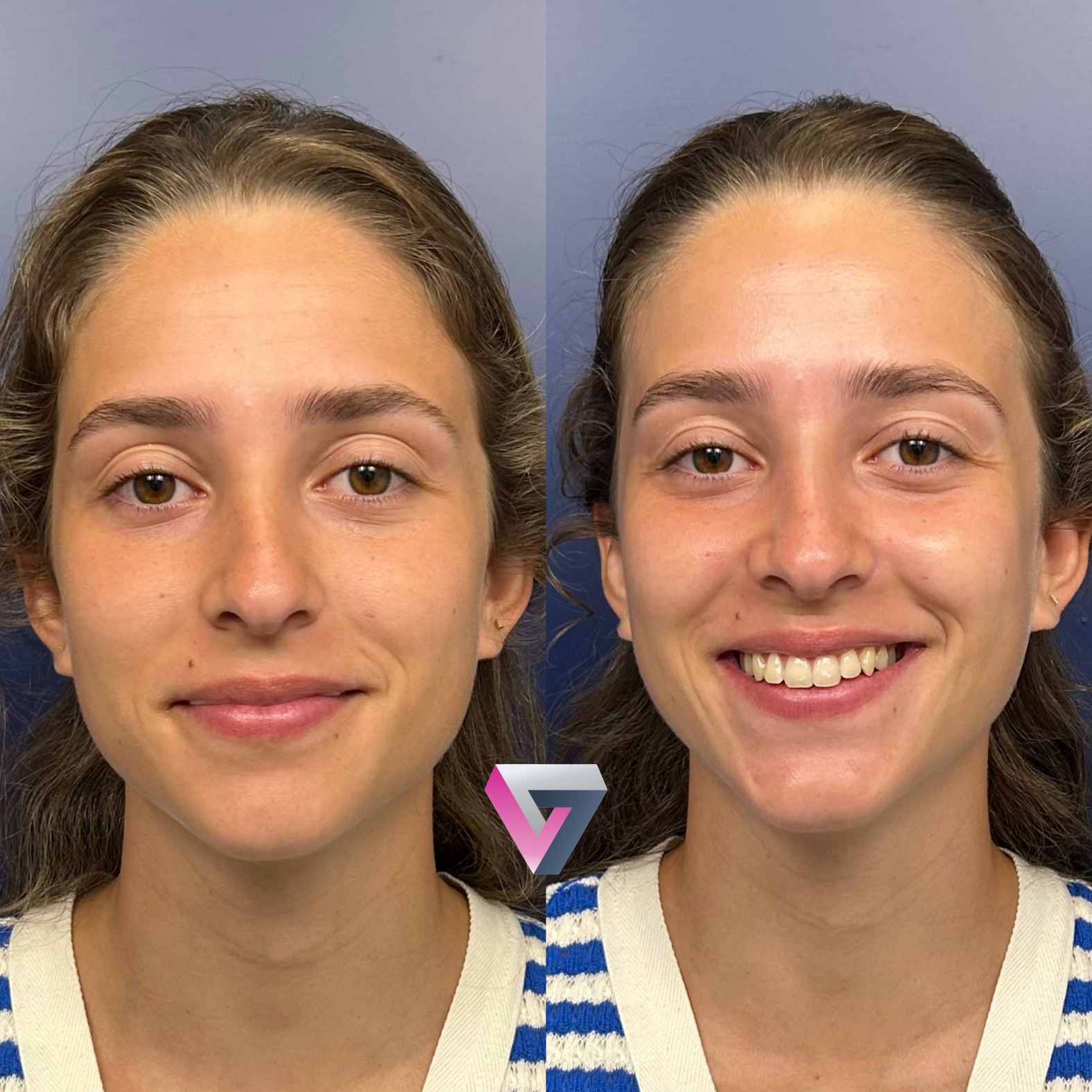 Antes y después de una limpieza facial reaizada en la consulta de medicina estética de la doctora Trasmonte