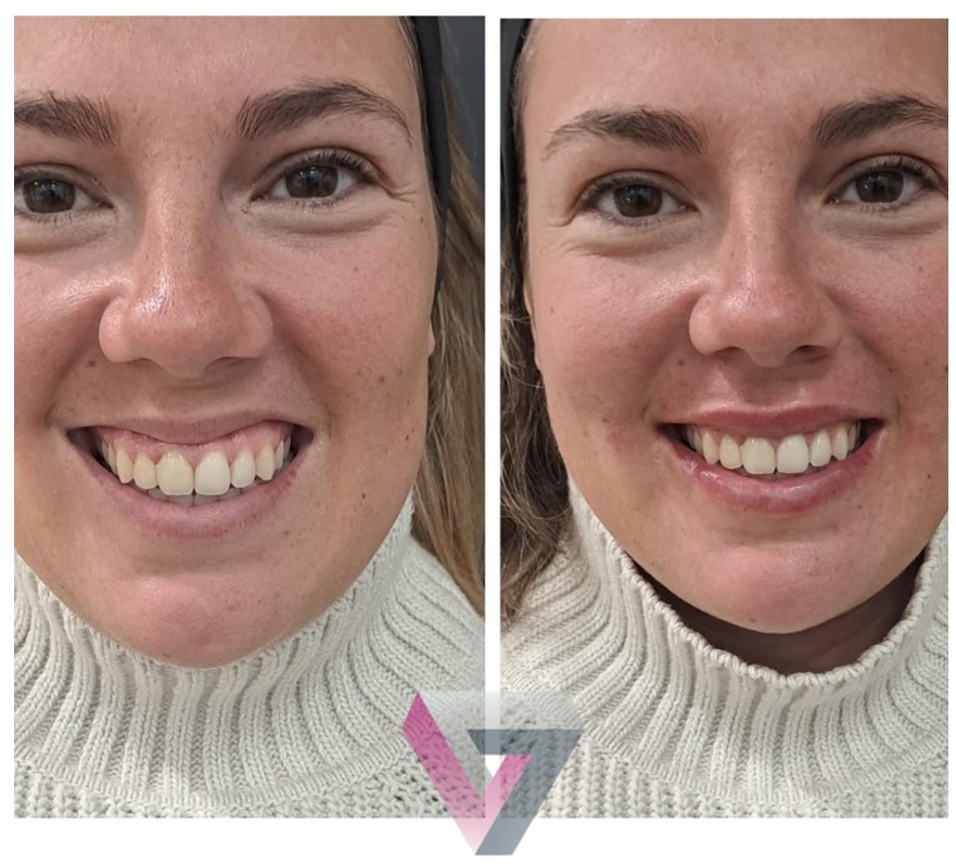 Resultados antes y después del tratamiento sonrisa gingival, consulta de la doctora Trasmonte
