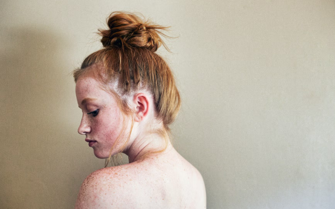 Mujer joven con pecas y el cabello recogido en moño, mostrando la piel del rostro y los hombros, en una imagen que ilustra el tema de las manchas en la piel.