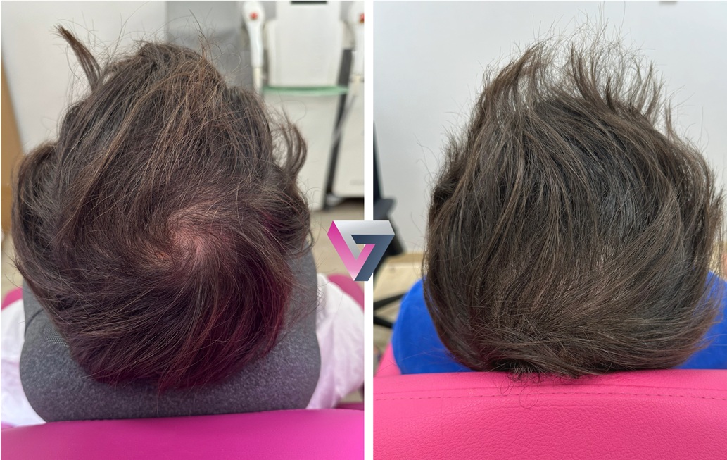 Antes y después de paciente con tratamiento de mesoterapia capilar en la consulta de la doctora Trasmonte 