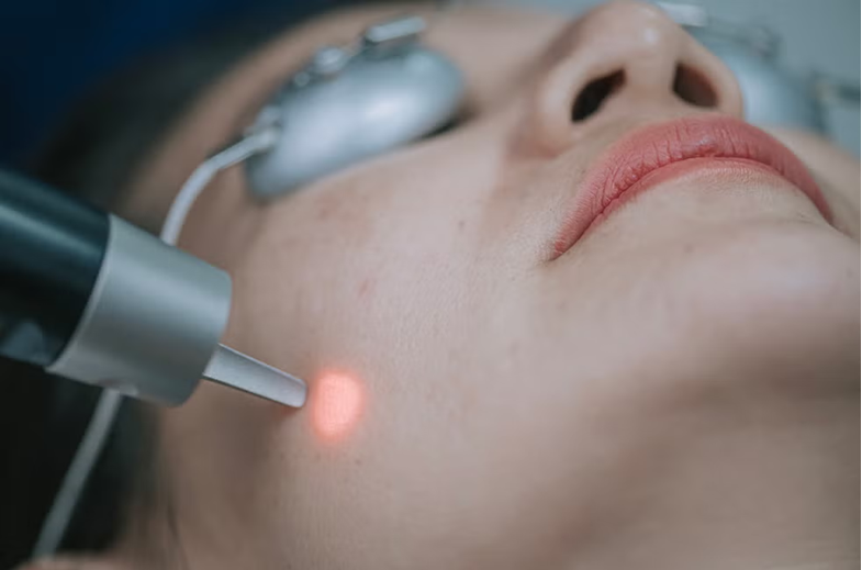 Paciente recibiendo tratamiento facial con láser o luz pulsada para eliminar manchas en la piel, procedimiento habitual en medicina estética.
