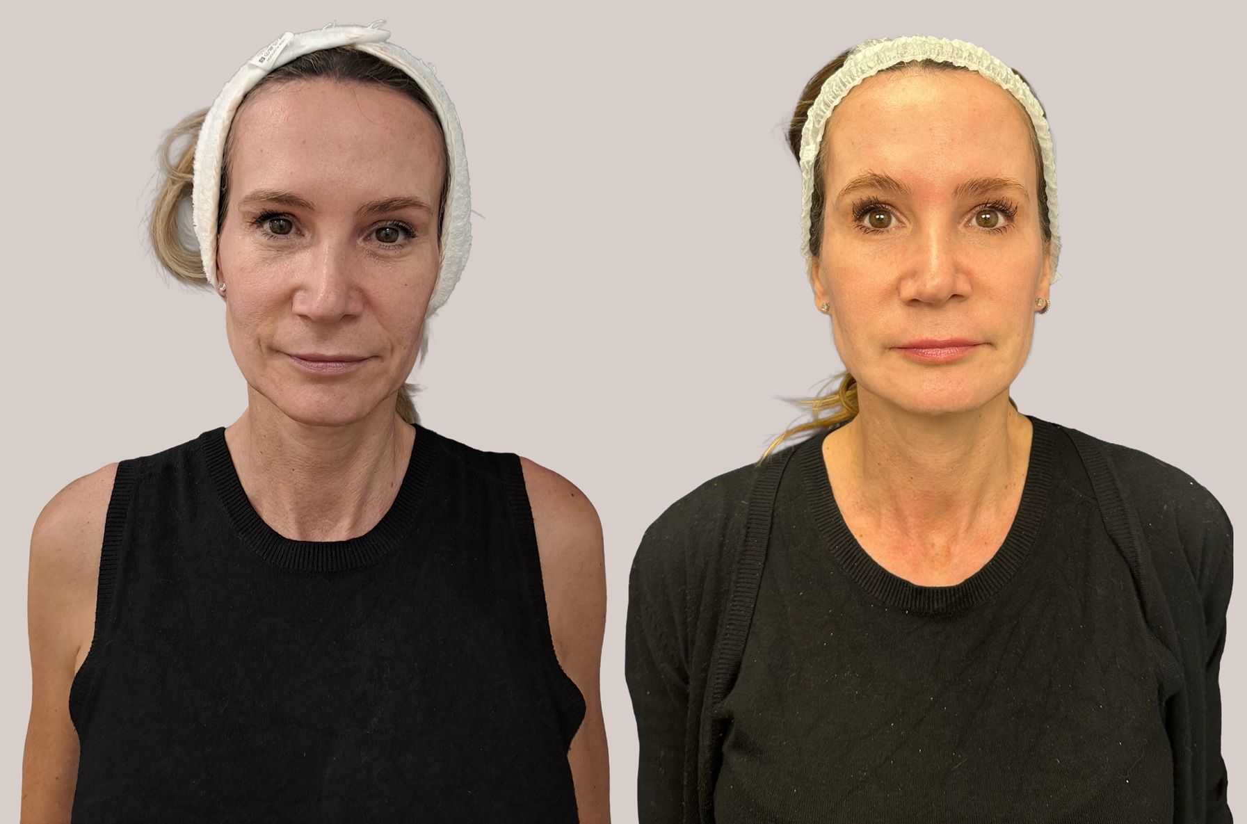 Antes y después de un tratamiento de arrugas con ácido hialurónico en la consulta de la doctora Trasmonte