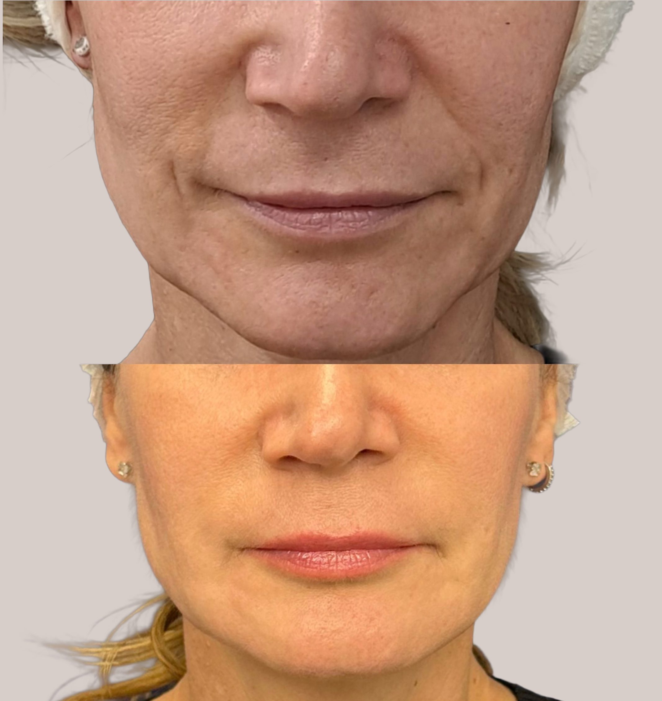 Antes y después del tratamiento de ácido hialurónico en el surco nasogeniano, mostrando la mejora en volumen, suavidad y armonía facial realizada por la Dra. Victoria Trasmonte.