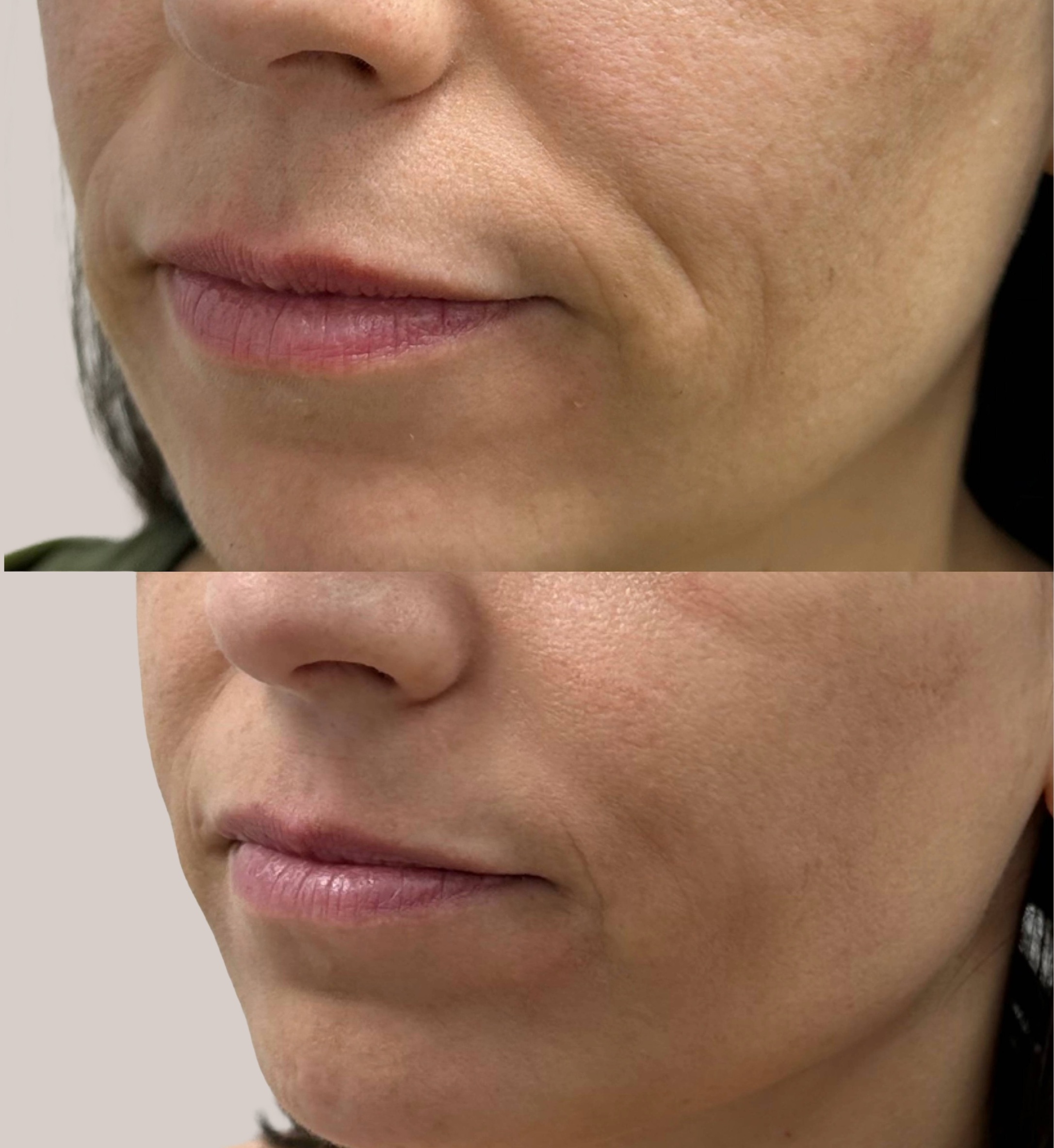 Resultado antes y después del tratamiento de ácido hialurónico en surcos nasogenianos, destacando la reducción del pliegue y una apariencia más descansada y uniforme del rostro.