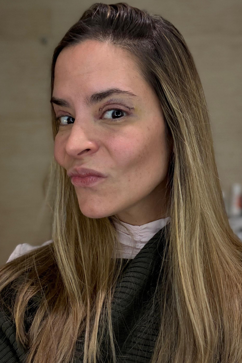 Blefaroplastia superior día 3 postoperatorio con disminución de inflamación y evolución de cicatrización