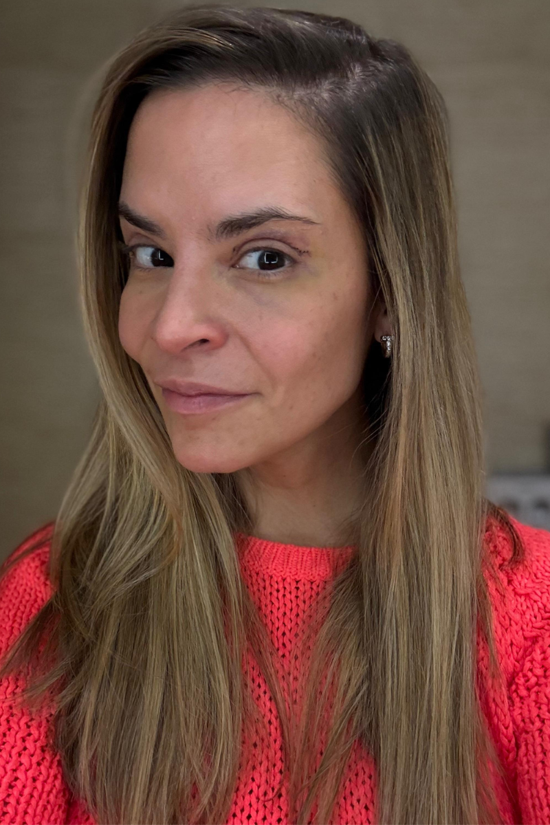 Blefaroplastia superior día 4 postoperatorio con inflamación mínima y evolución favorable de cicatrización