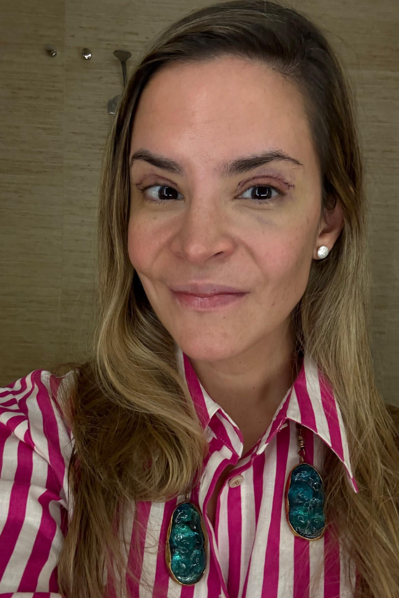 Blefaroplastia superior día 5 postoperatorio con mirada más despejada y cicatrización avanzada