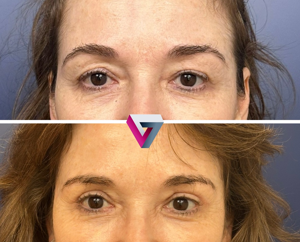 Resultado antes y después de blefaroplastia para rejuvenecer la mirada con la Dra. Victoria Trasmonte en Madrid