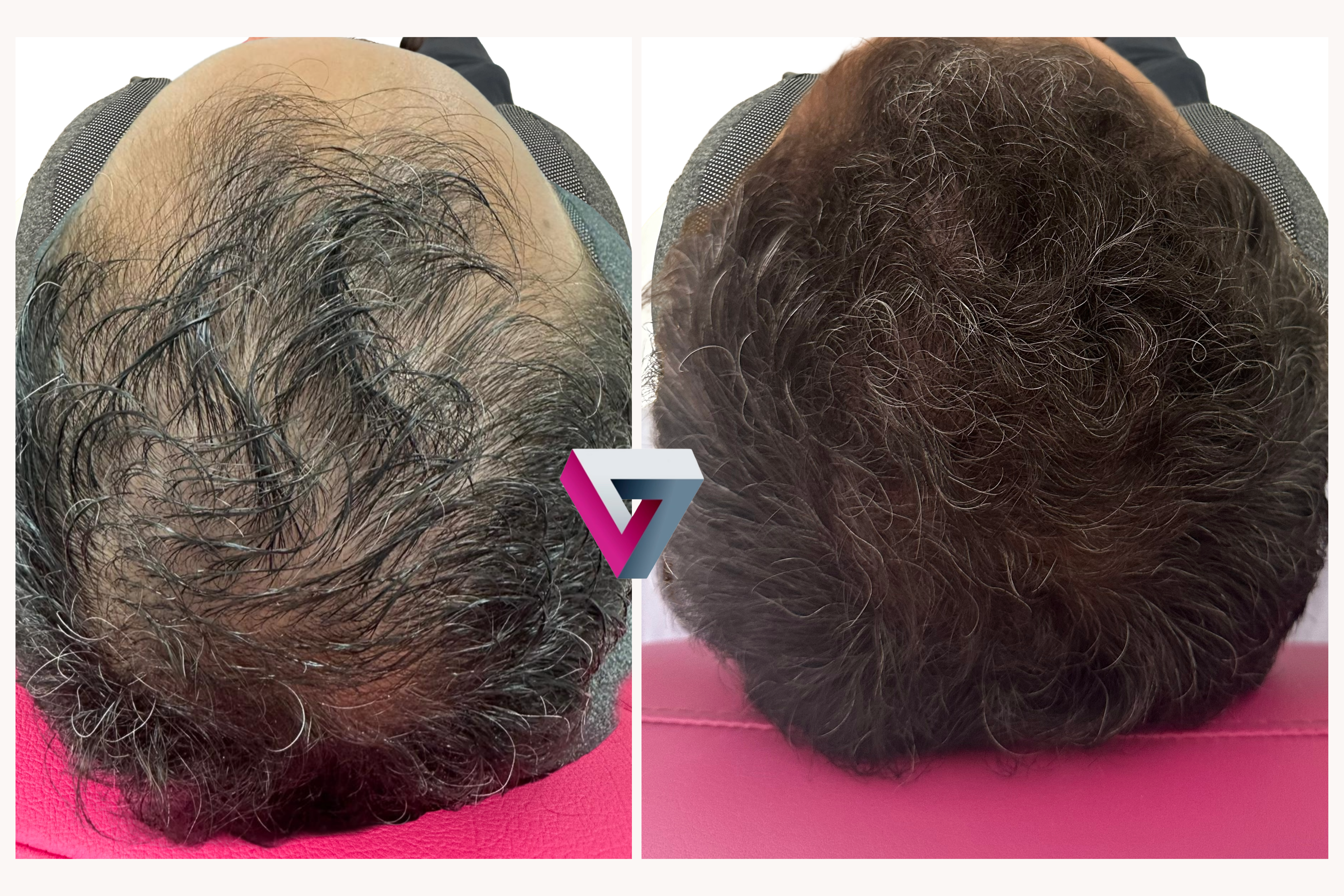 Antes y después del tratamiento de caída capilar en hombre tras mesoterapia capilar