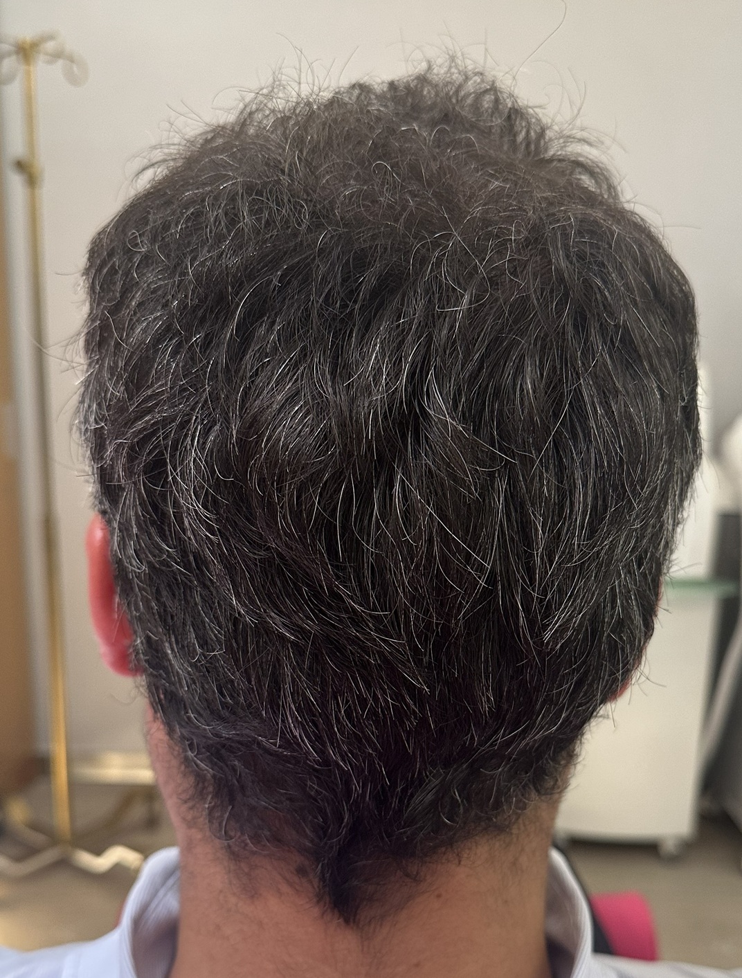Resultados de mesoterapia capilar en hombre tras 8 sesiones de tratamiento