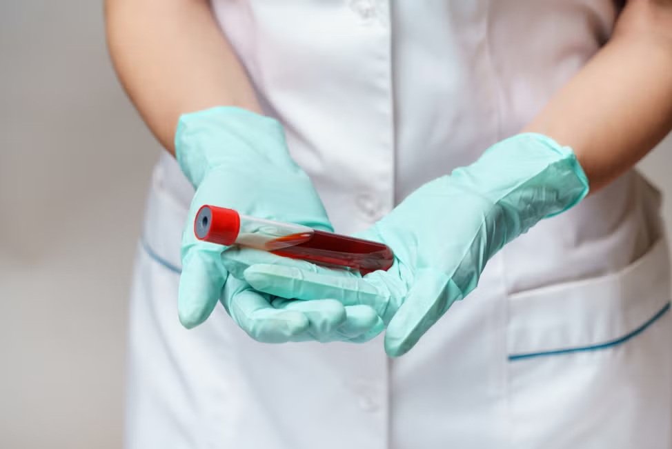 Profesional sanitario sosteniendo una muestra de sangre para un tratamiento de plasmaféresis y renovación del plasma sanguíneo.
