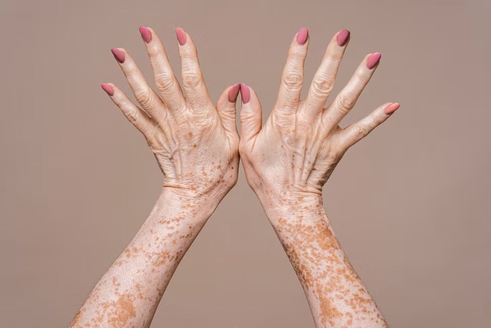 Manos con manchas solares y signos de envejecimiento, que pueden tratarse con tratamientos de medicina estética para rejuvenecer la piel de las manos